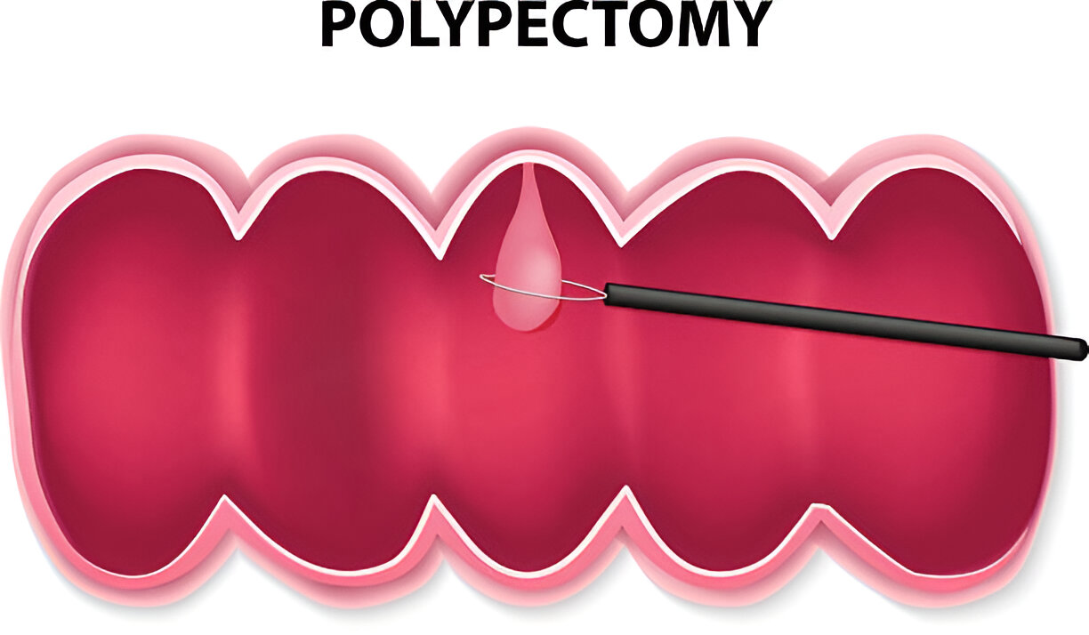 polypectomy